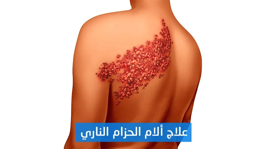 علاج آلام الحزام الناري