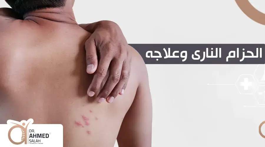 الحزام الناري وعلاجه