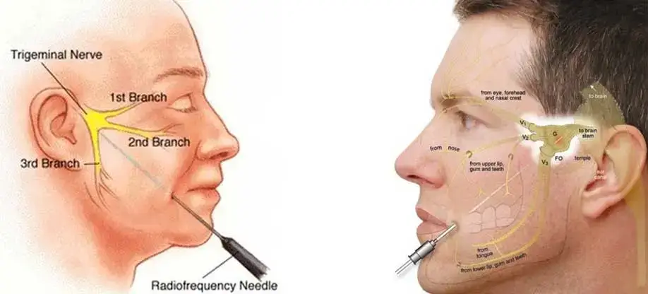 سعر العلاج بالتردد الحراري للعصب الخامس
